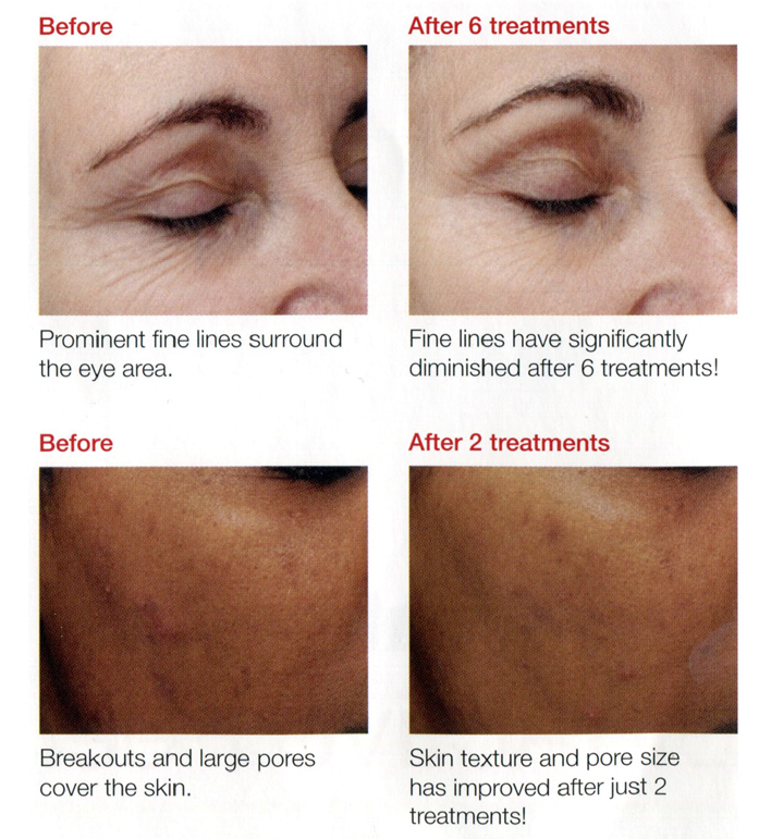 ProSkin 90 Biosurface Peel